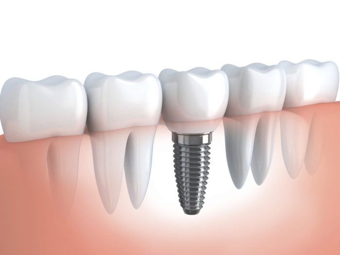 Dental Implants in Altamonte Springs Florida